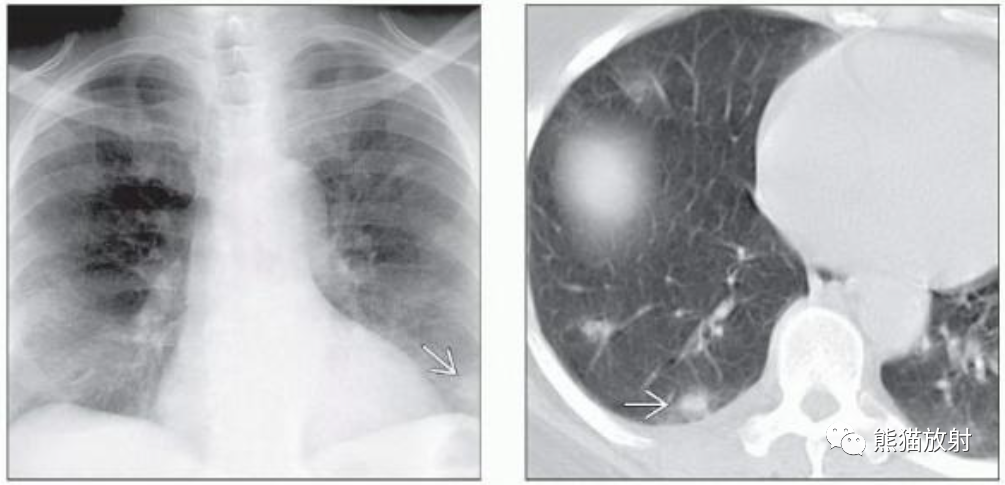 肺曲霉菌病、肺隐球菌病影像表现-6