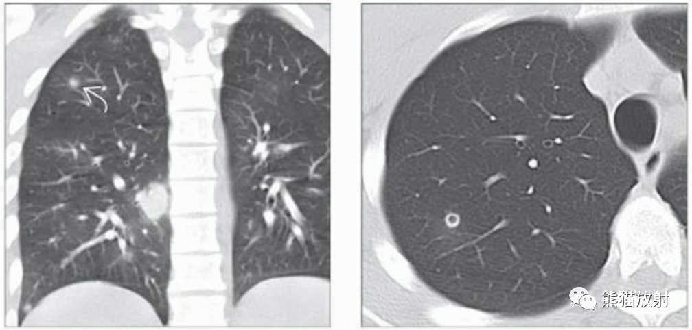 肺曲霉菌病、肺隐球菌病影像表现-7