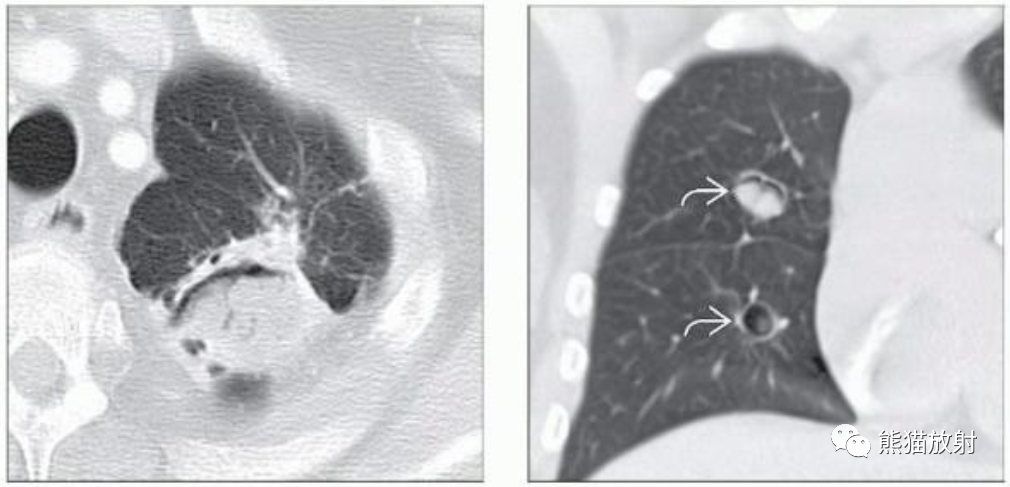 肺曲霉菌病、肺隐球菌病影像表现-8