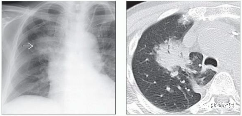 肺曲霉菌病、肺隐球菌病影像表现-9