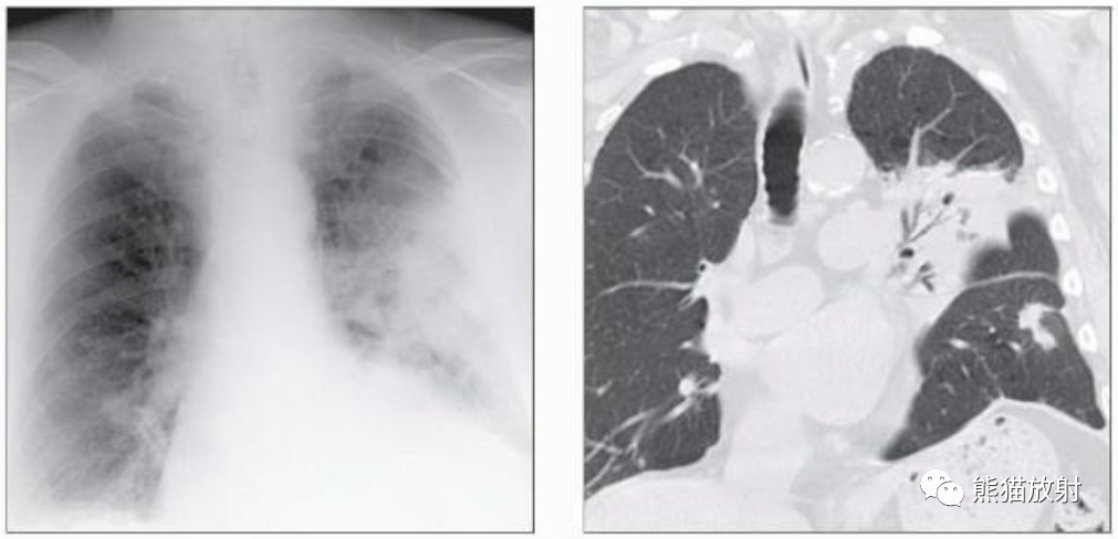 肺曲霉菌病、肺隐球菌病影像表现-10