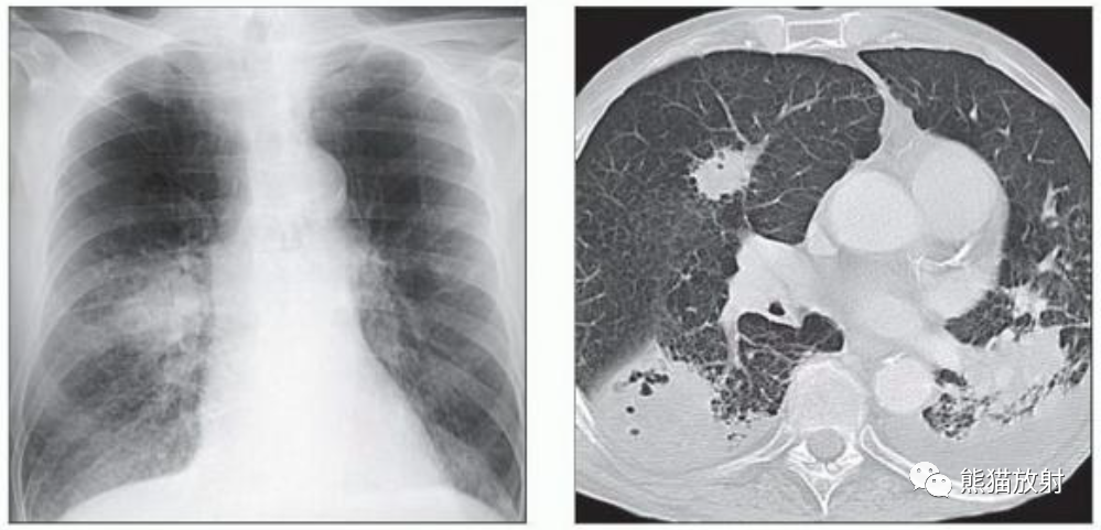 肺曲霉菌病、肺隐球菌病影像表现-11