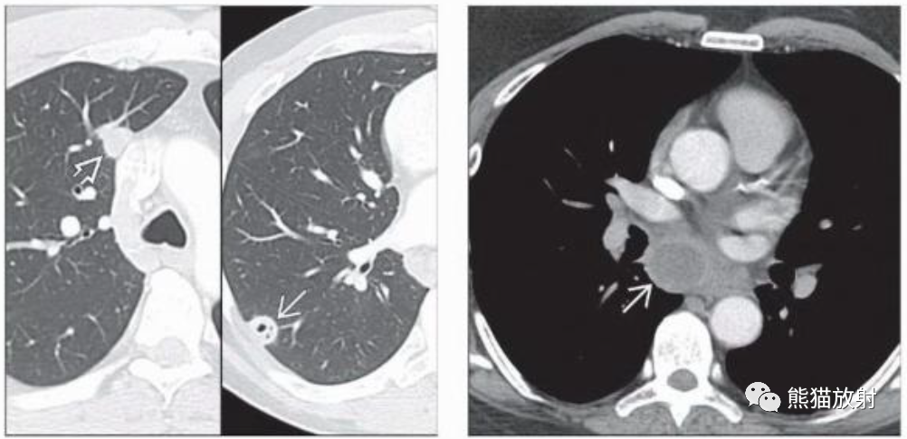 肺曲霉菌病、肺隐球菌病影像表现-12