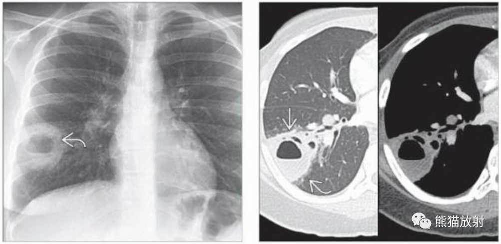 肺曲霉菌病、肺隐球菌病影像表现-13