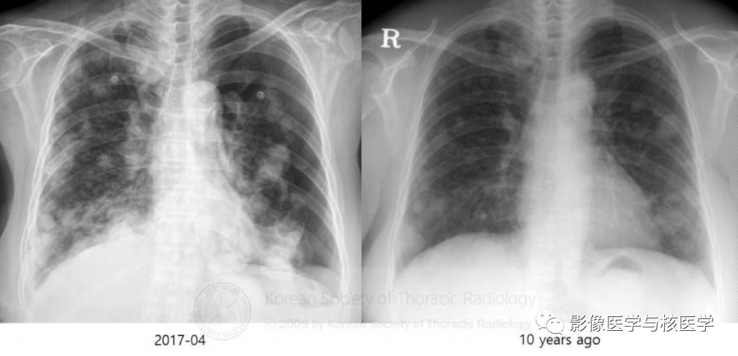 【病例】肺良性转移性平滑肌瘤病1例CT影像-1