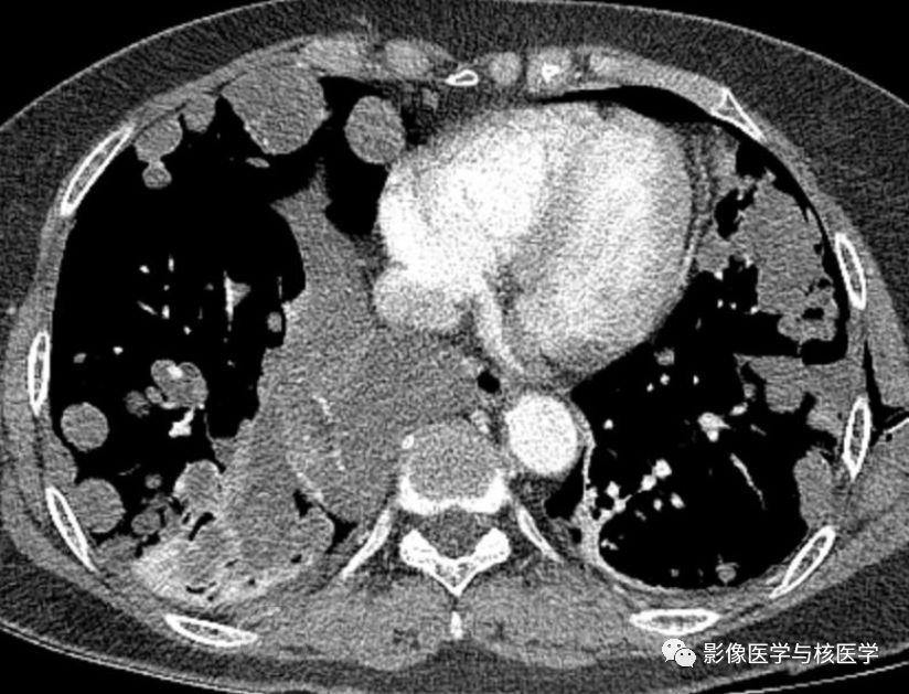 【病例】肺良性转移性平滑肌瘤病1例CT影像-2