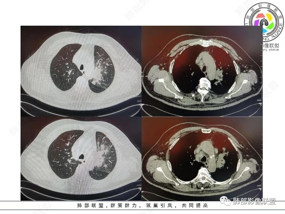 【病例】肺部这样的片状影,你是否能一锤定音?-5 【病例】肺部这样的片状影,你是否能一锤定音?-5