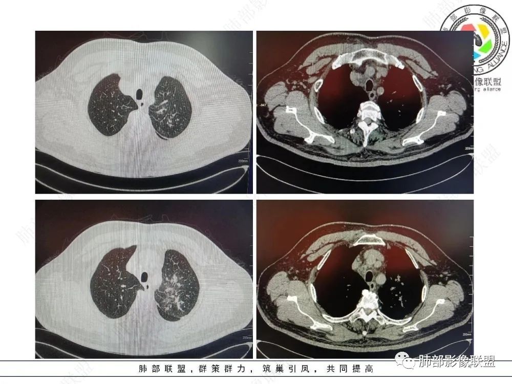 【病例】肺部这样的片状影,你是否能一锤定音?-4 【病例】肺部这样的片状影,你是否能一锤定音?-4