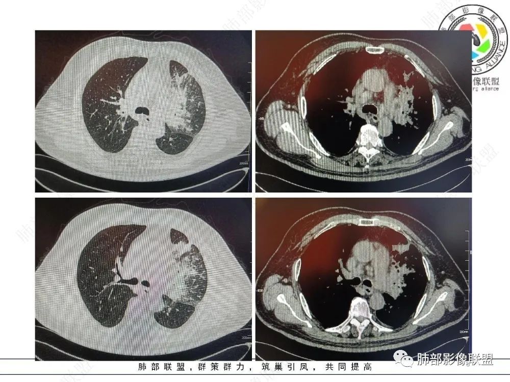 【病例】肺部这样的片状影,你是否能一锤定音?-6 【病例】肺部这样的片状影,你是否能一锤定音?-6