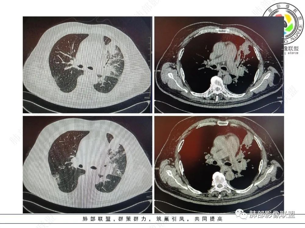 【病例】肺部这样的片状影,你是否能一锤定音?-7 【病例】肺部这样的片状影,你是否能一锤定音?-7