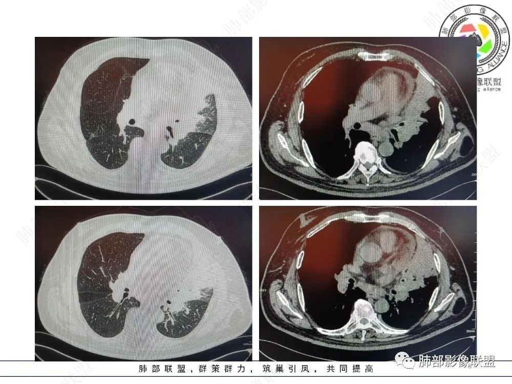 【病例】肺部这样的片状影,你是否能一锤定音?-8 【病例】肺部这样的片状影,你是否能一锤定音?-8
