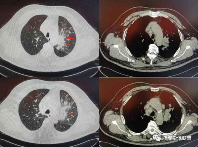 【病例】肺部这样的片状影，你是否能一锤定音？-14