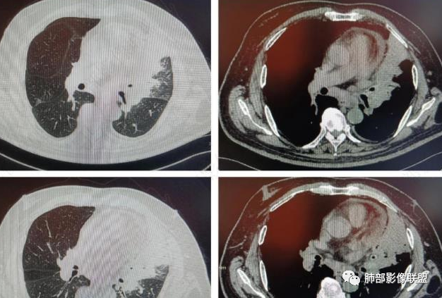 【病例】肺部这样的片状影，你是否能一锤定音？-16