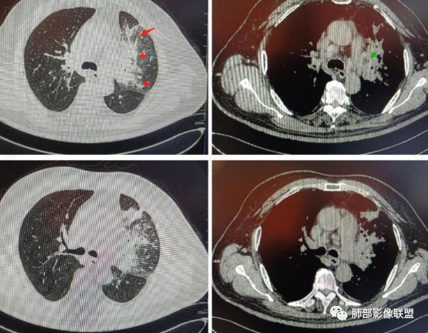【病例】肺部这样的片状影，你是否能一锤定音？-15