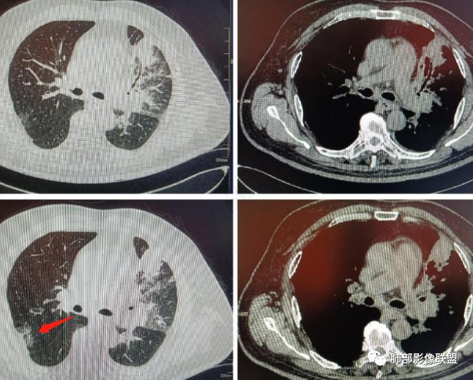 【病例】肺部这样的片状影，你是否能一锤定音？-17