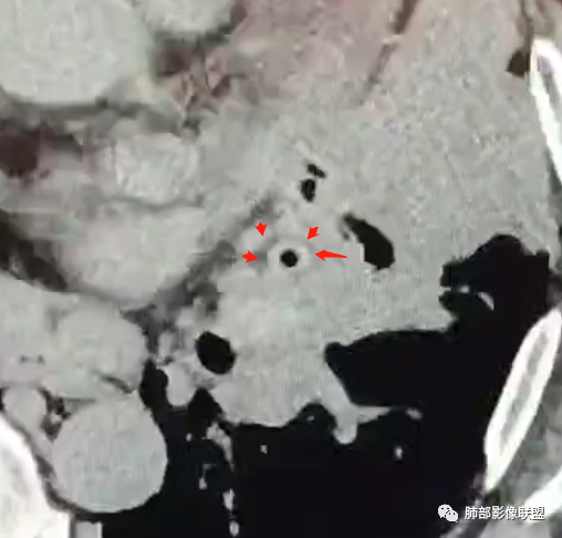 【病例】肺部这样的片状影，你是否能一锤定音？-18