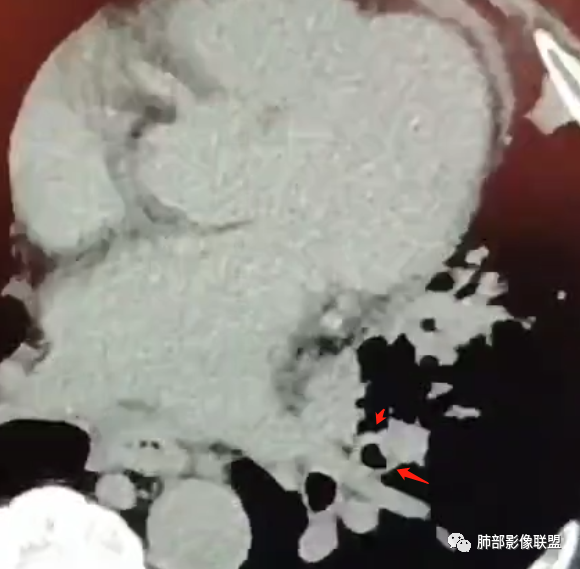 【病例】肺部这样的片状影，你是否能一锤定音？-19