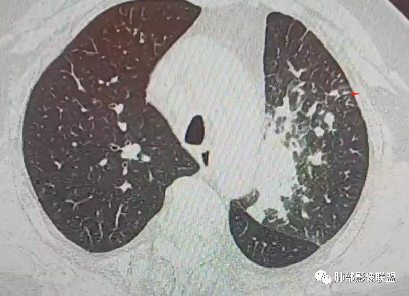 【病例】肺部这样的片状影，你是否能一锤定音？-21