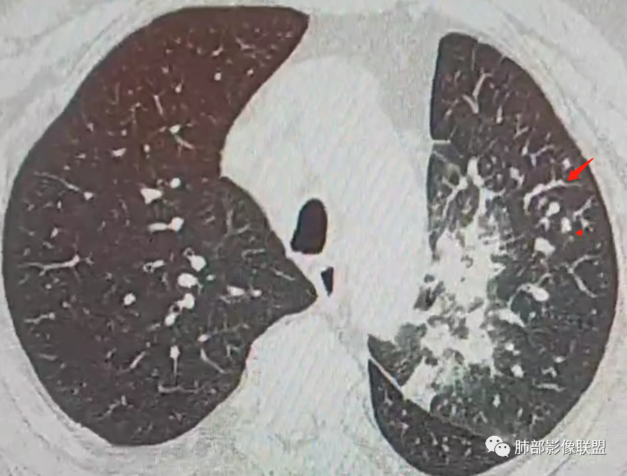 【病例】肺部这样的片状影，你是否能一锤定音？-20