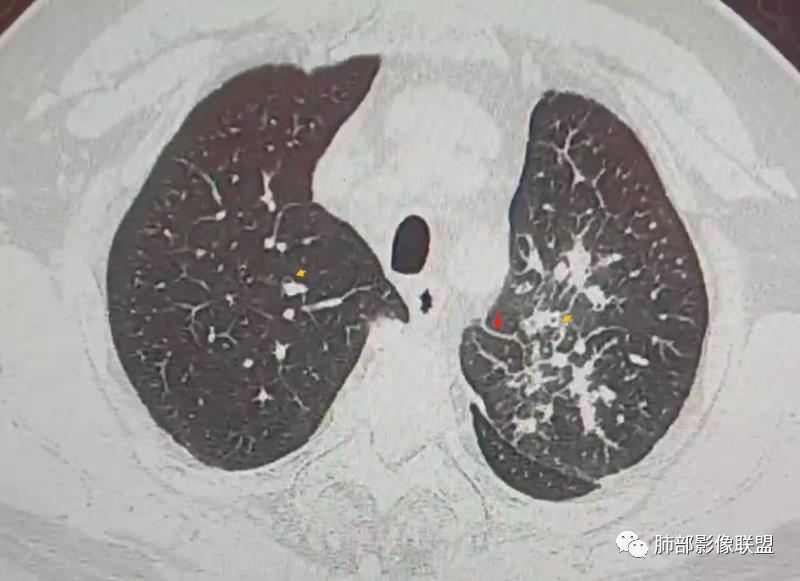 【病例】肺部这样的片状影，你是否能一锤定音？-22