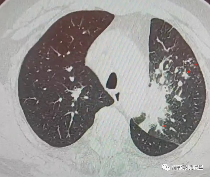 【病例】肺部这样的片状影，你是否能一锤定音？-23