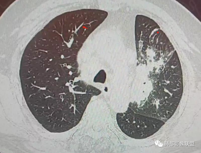 【病例】肺部这样的片状影，你是否能一锤定音？-24