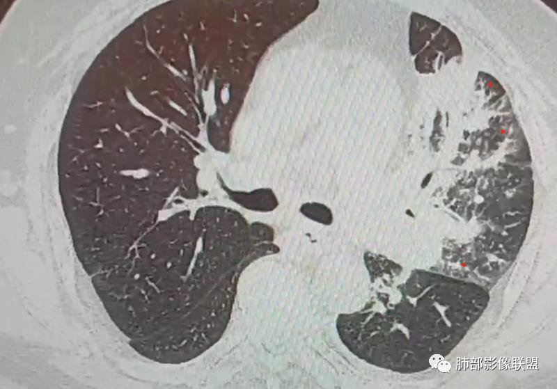 【病例】肺部这样的片状影，你是否能一锤定音？-25