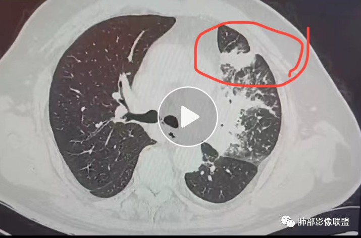 【病例】肺部这样的片状影,你是否能一锤定音?-26 【病例】肺部这样的片状影,你是否能一锤定音?-26