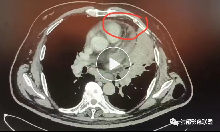 【病例】肺部这样的片状影,你是否能一锤定音?-27 【病例】肺部这样的片状影,你是否能一锤定音?-27