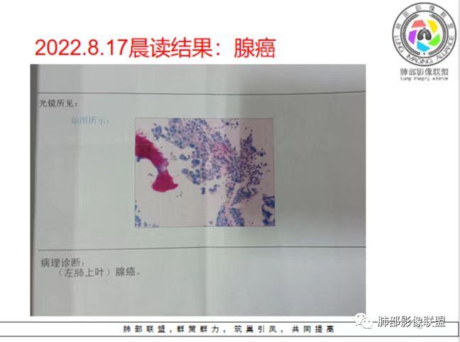 【病例】肺部这样的片状影,你是否能一锤定音?-28 【病例】肺部这样的片状影,你是否能一锤定音?-28