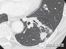 【病例】肺部这样的片状影，你是否能一锤定音？-29