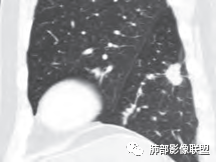 【病例】肺部这样的片状影，你是否能一锤定音？-30