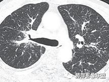 【病例】肺部这样的片状影，你是否能一锤定音？-31