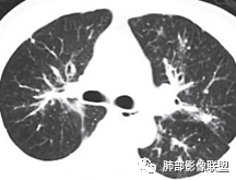 【病例】肺部这样的片状影，你是否能一锤定音？-33