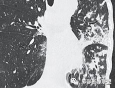 【病例】肺部这样的片状影，你是否能一锤定音？-34
