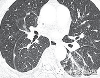 【病例】肺部这样的片状影，你是否能一锤定音？-32