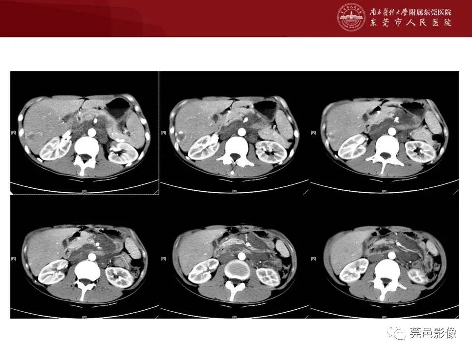 【病例】马尔尼菲蓝状菌感染1例影像学表现-5