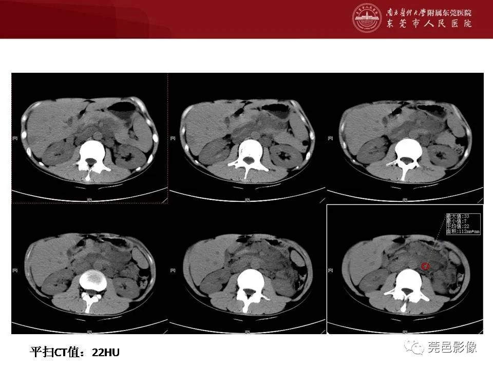 【病例】马尔尼菲蓝状菌感染1例影像学表现-3