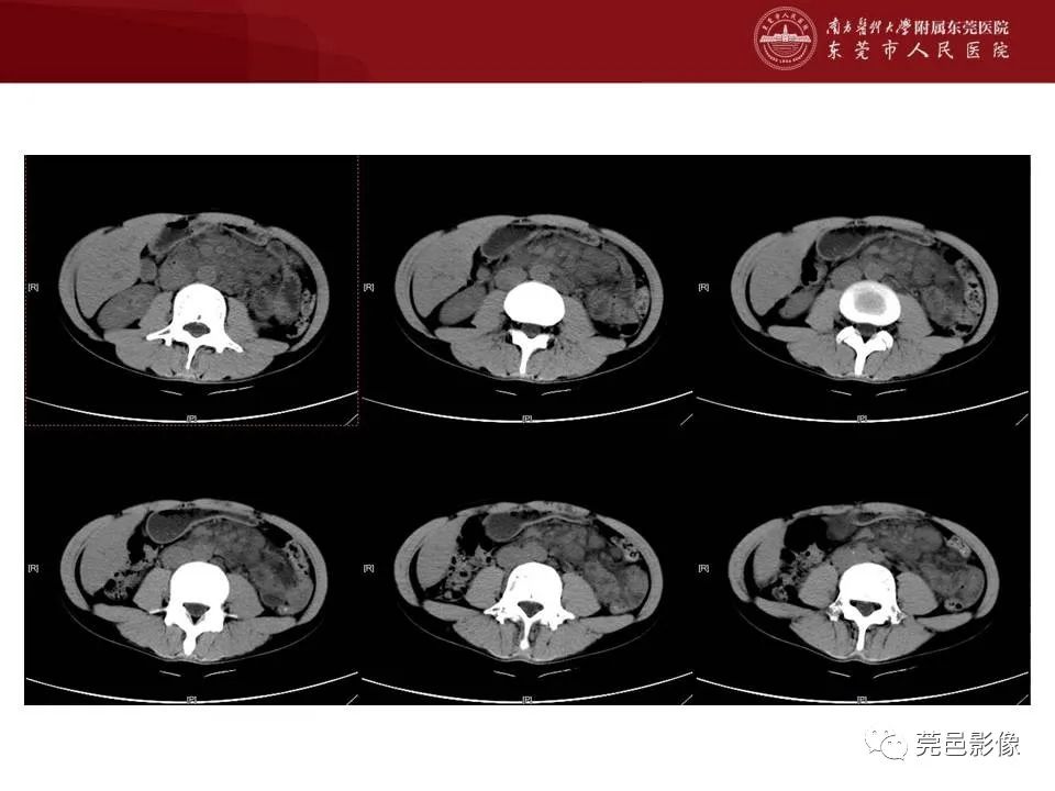 【病例】马尔尼菲蓝状菌感染1例影像学表现-4