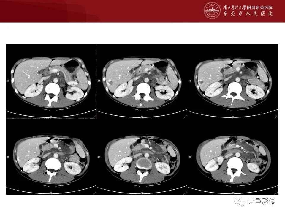 【病例】马尔尼菲蓝状菌感染1例影像学表现-7