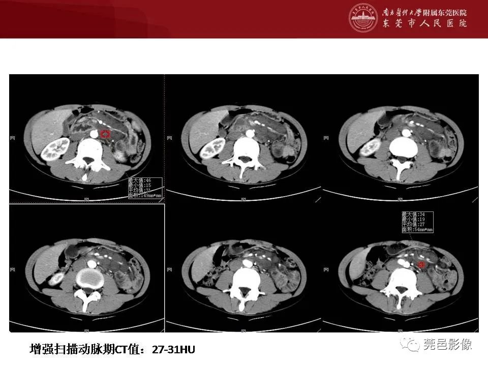 【病例】马尔尼菲蓝状菌感染1例影像学表现-6