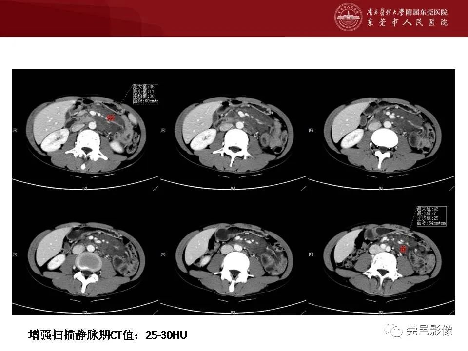 【病例】马尔尼菲蓝状菌感染1例影像学表现-8