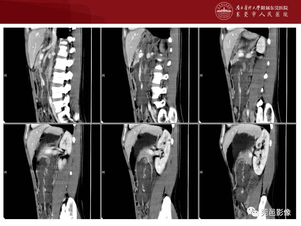 【病例】马尔尼菲蓝状菌感染1例影像学表现-10