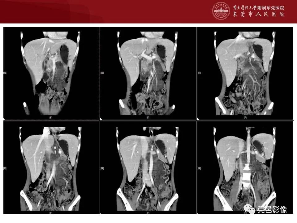 【病例】马尔尼菲蓝状菌感染1例影像学表现-9