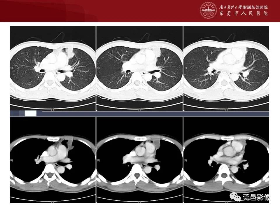【病例】马尔尼菲蓝状菌感染1例影像学表现-11