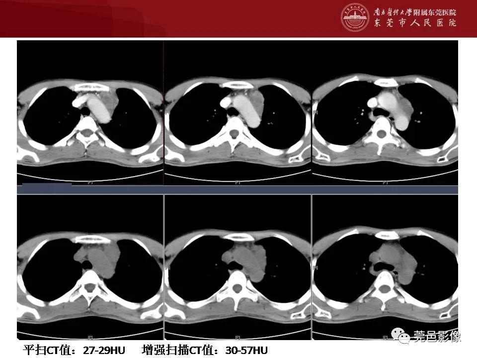 【病例】马尔尼菲蓝状菌感染1例影像学表现-12