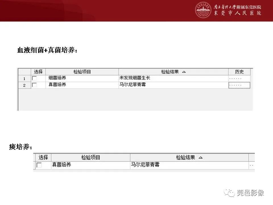 【病例】马尔尼菲蓝状菌感染1例影像学表现-15