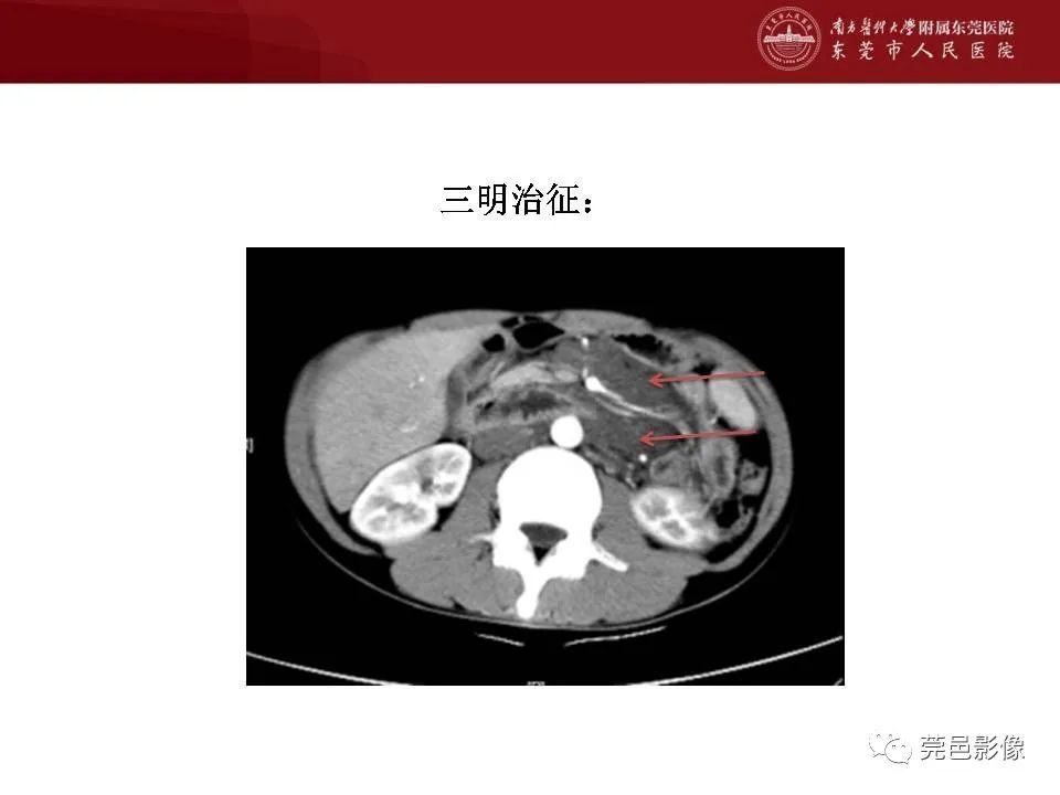 【病例】马尔尼菲蓝状菌感染1例影像学表现-18