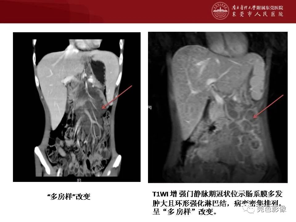 【病例】马尔尼菲蓝状菌感染1例影像学表现-20