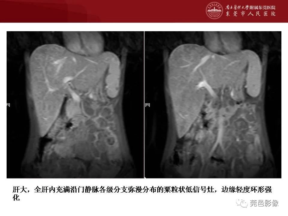 【病例】马尔尼菲蓝状菌感染1例影像学表现-23